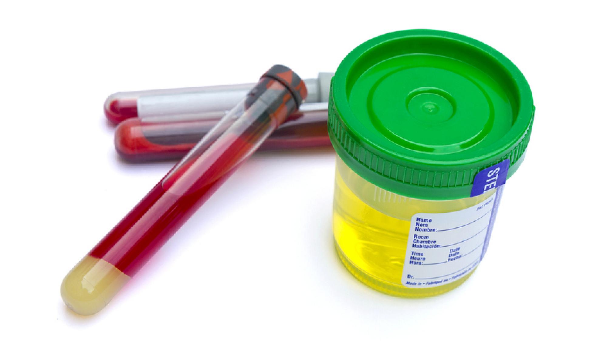 Blood and urine lab test tube sample